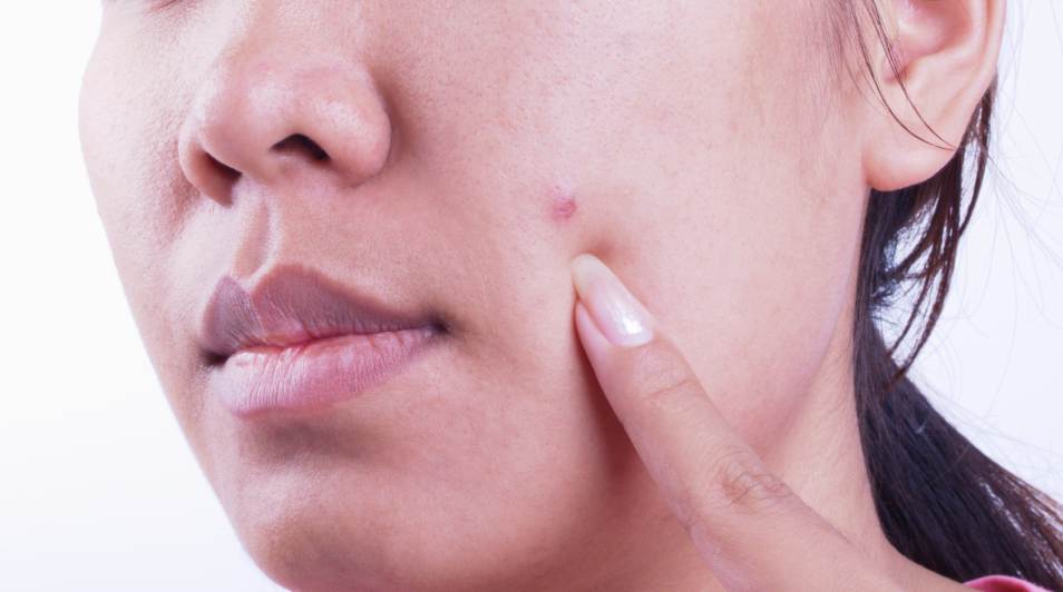 Can skin cancer look like a pimple?